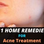 11 Home Remedies for Acne Treatment